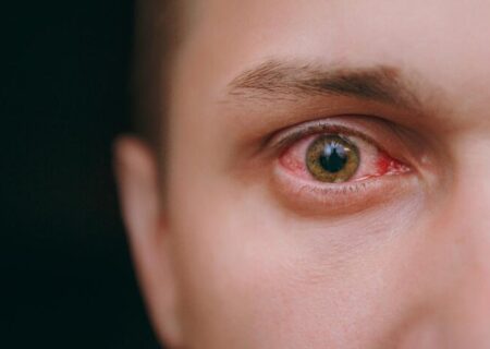التهاب چشم صورتی؛ نشانه جدید بیماری کرونا