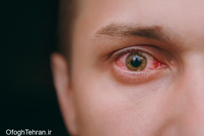 علل خشکی چشم